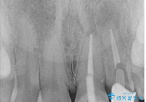 折れてしまって変色した前歯をオールセラミックにの治療前