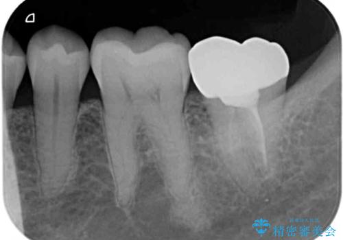 奥歯が割れた 神経が取り除かれた歯のセラミッククラウン治療の治療後