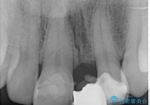 オールセラミッククラウン 変色した前歯を白く綺麗な歯への治療前