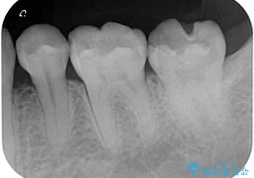 奥歯の虫歯をセラミックインレーにて修復治療の治療前