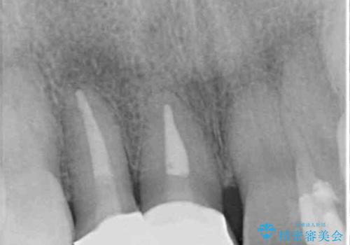 変色した前歯のオールセラミック治療の治療後