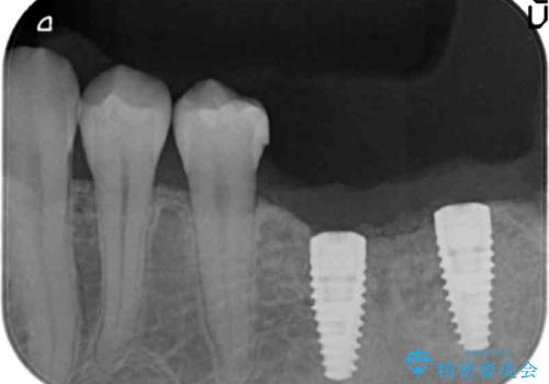 臼歯の噛み合わせをインプラントを用いて回復するの治療中