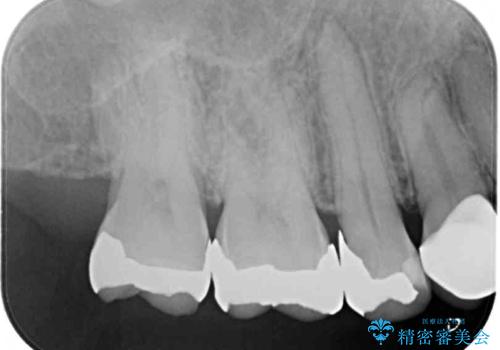 痛みが続く銀歯をセラミックにの治療前