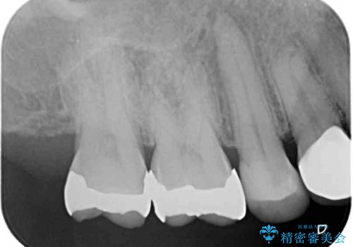 痛みが続く銀歯をセラミックにの治療後