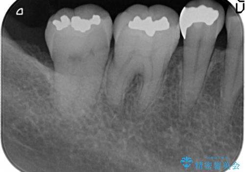 セラミックインレー 古い銀歯をやり直したいの治療前