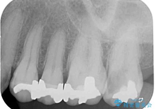 奥歯の虫歯と歯茎の腫れをセラミッククラウンで治療の治療前