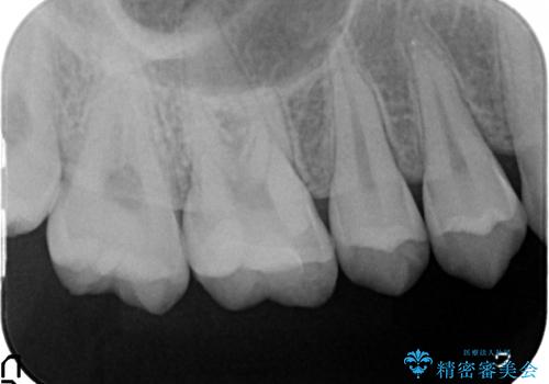 検診による初期虫歯の早期発見・早期治療の治療後