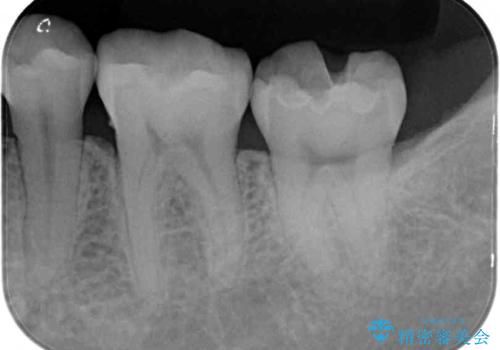 奥歯の虫歯をセラミックインレーにて修復治療の治療後