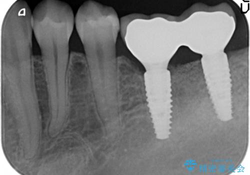 臼歯の噛み合わせをインプラントを用いて回復するの治療後