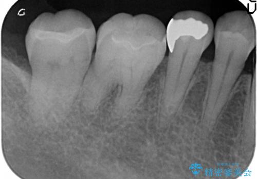 セラミックインレー 古い銀歯をやり直したいの治療後