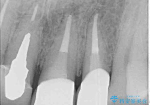 歯が痛い 前歯のセラミック治療の治療後