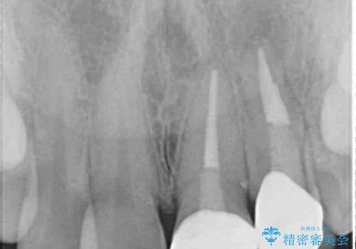 折れてしまって変色した前歯をオールセラミックにの治療後