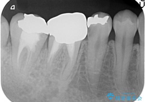 PGA(ゴールド)インレー　深い虫歯の虫歯の治療の治療前