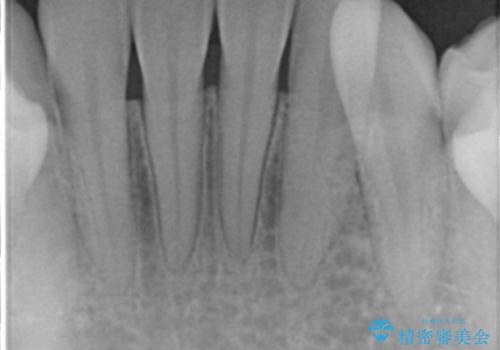 歯周初期治療の重要性の治療後