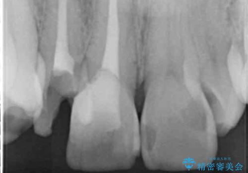 奥に引っ込んでいる歯をセラミックでかぶせたい 補綴前矯正 50代男性の治療前