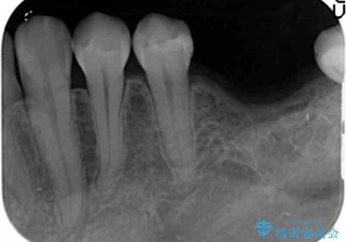 臼歯の噛み合わせをインプラントを用いて回復するの治療前