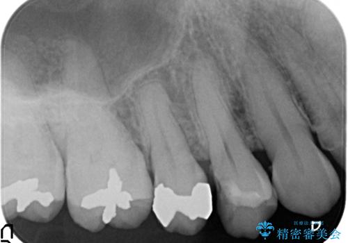 セラミックインレー 古い樹脂の修復の治療前