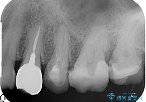 放置してしまった深い虫歯の治療の治療前