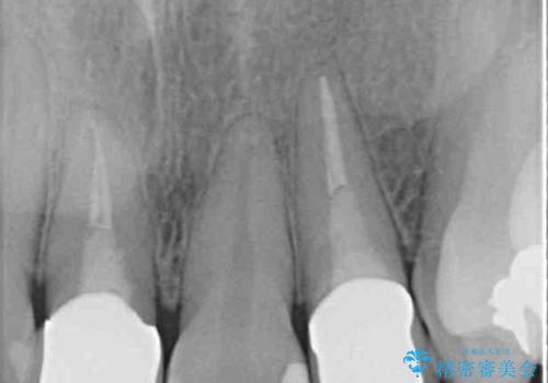 裏打ちが金属のセラミッククラウンをオールセラミッククラウンで自然にの治療後
