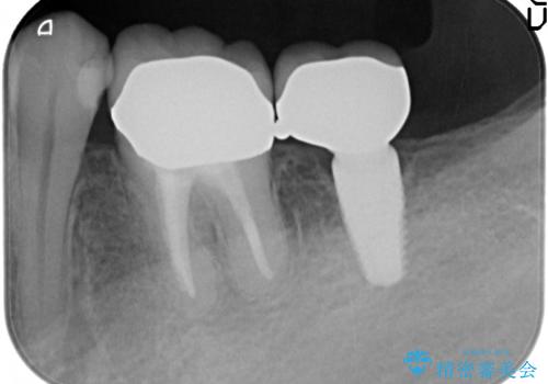 不適合ブリッジの除去  インプラントによる咬合再構成の治療後