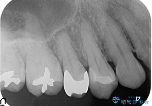 セラミックインレー 古い樹脂の修復の治療後