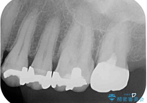 奥歯の虫歯と歯茎の腫れをセラミッククラウンで治療の治療後
