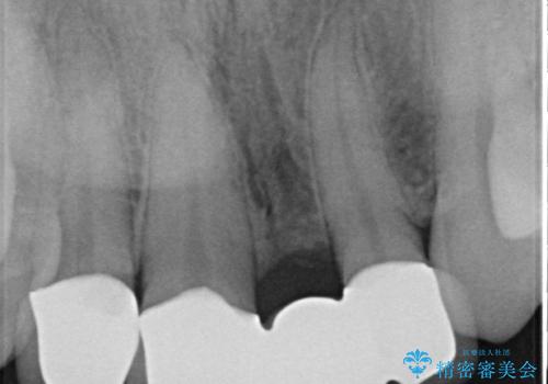 オールセラミッククラウン 変色した前歯を白く綺麗な歯への治療後