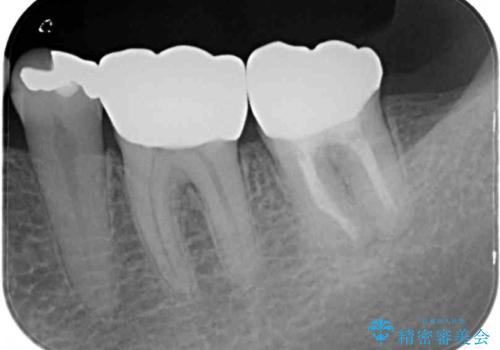 奥歯の虫歯と歯茎の腫れをセラミッククラウンで治療の治療後