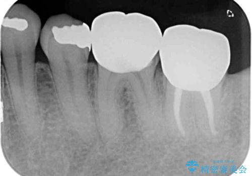 部分矯正を併用した奥歯のインプラント補綴治療の治療前