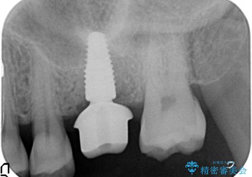 奥歯の欠損　インプラントによる咬合機能回復の治療中