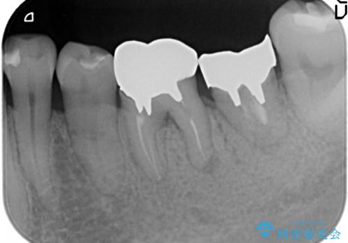 オールセラミッククラウン 外れてしまった銀歯の治療の治療前