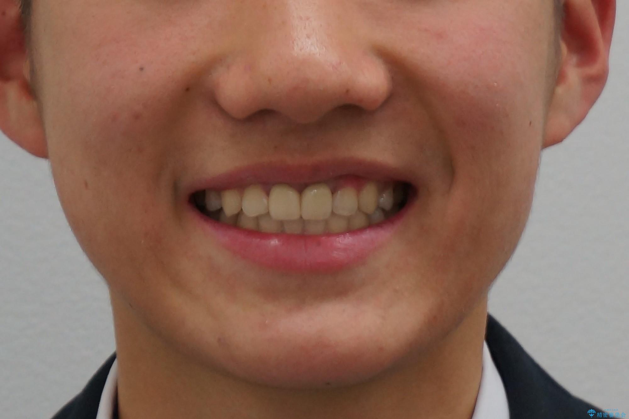 小さいころに前歯を折った がたがたの矯正+変色した前歯をセラミックにの治療後(顔貌)