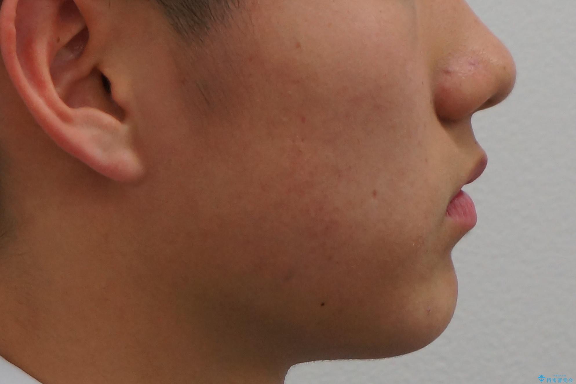 小さいころに前歯を折った がたがたの矯正+変色した前歯をセラミックにの治療後(顔貌)