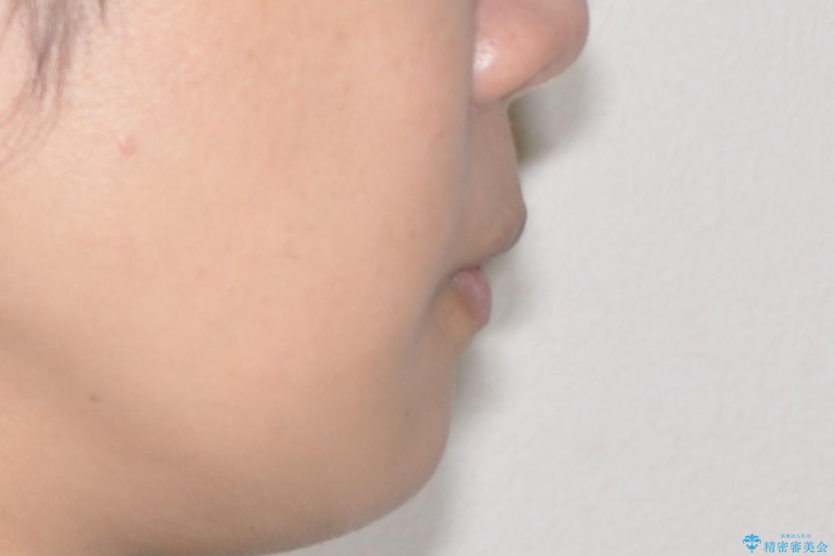 口元が出てるの気になる、引っ込めたい ワイヤーによる抜歯矯正で横顔の改善の治療後(顔貌)