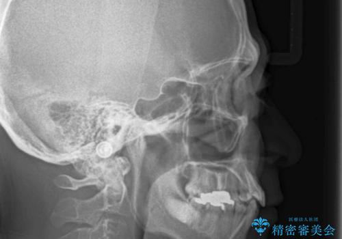 奥に引っ込んでいる歯をセラミックでかぶせたい 補綴前矯正 50代男性の治療前