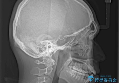 インビザラインで整った口元にの治療前