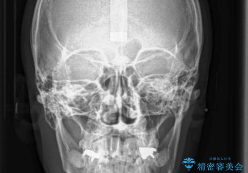 奥に引っ込んでいる歯をセラミックでかぶせたい 補綴前矯正 50代男性の治療前