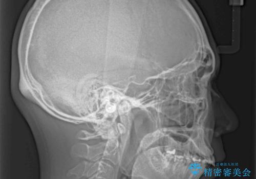 インビザライン矯正とインプラント補綴 深い咬み合わせと奥歯の欠損治療の治療前