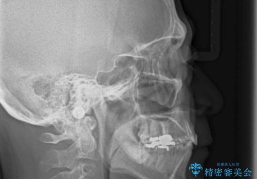 奥に引っ込んでいる歯をセラミックでかぶせたい 補綴前矯正 50代男性の治療後