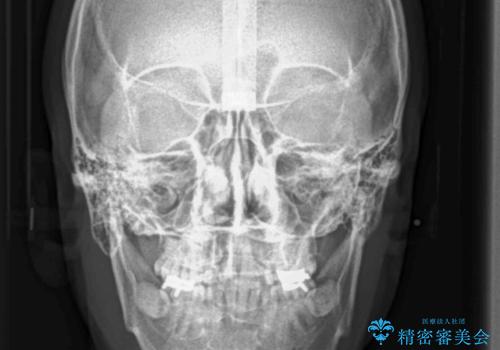 奥に引っ込んでいる歯をセラミックでかぶせたい 補綴前矯正 50代男性の治療後