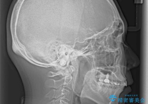 インビザライン矯正とインプラント補綴 深い咬み合わせと奥歯の欠損治療の治療後