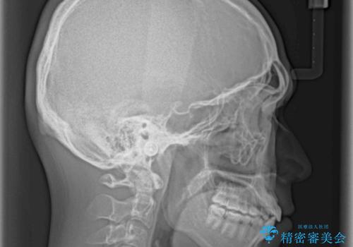 インビザラインで整った口元にの治療後