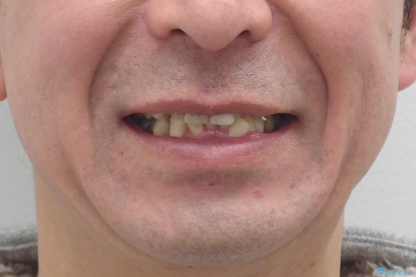 奥に引っ込んでいる歯をセラミックでかぶせたい 補綴前矯正 50代男性の治療前(顔貌)