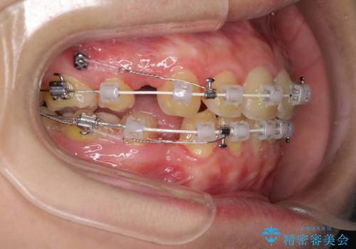 口元が出てるの気になる、引っ込めたい ワイヤーによる抜歯矯正で横顔の改善の治療中