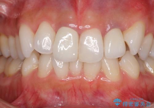 裏打ちが金属のセラミッククラウンをオールセラミッククラウンで自然に