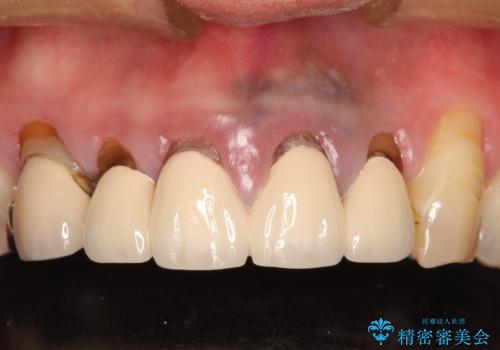 上の前歯の根元が黒い 根の治療を含めたセラミック再治療の治療前