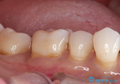 治療したむし歯の再治療。セラミックにしたい!の治療後