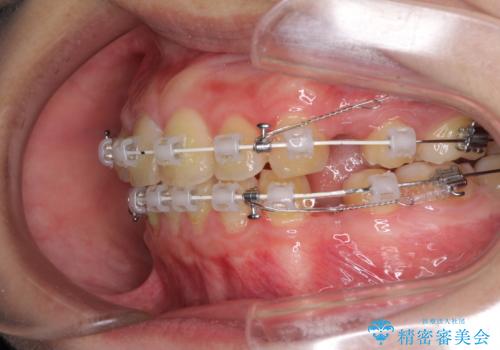 口元が出てるの気になる、引っ込めたい ワイヤーによる抜歯矯正で横顔の改善の治療中