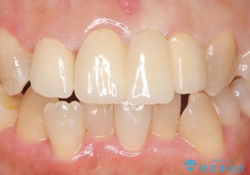 オールセラミッククラウン 変色した前歯を白く綺麗な歯への治療後