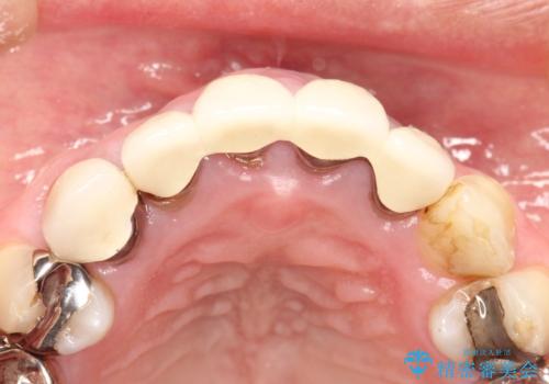 上の前歯の根元が黒い 根の治療を含めたセラミック再治療の治療前